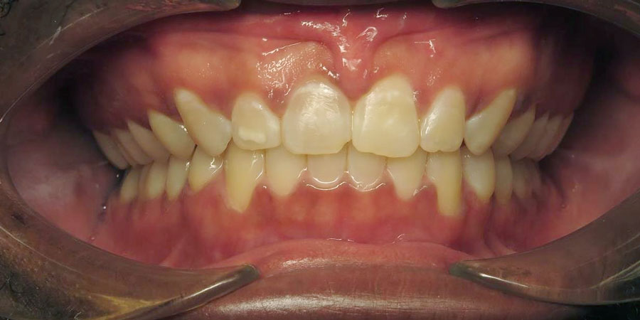 After treatment